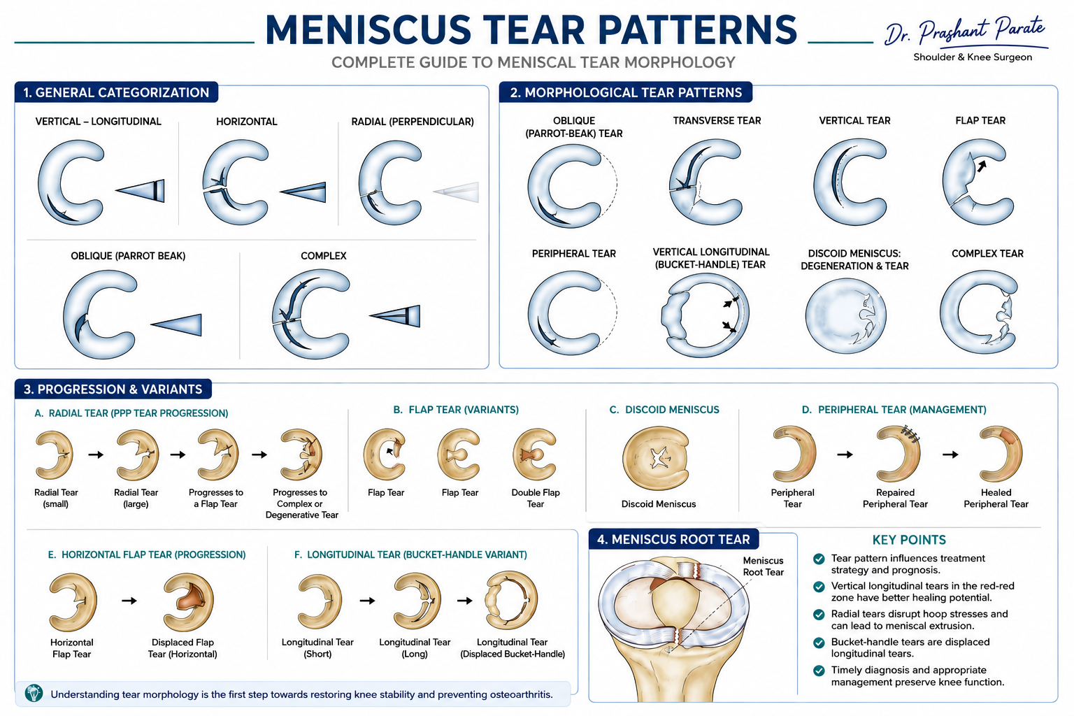 Meniscus tear patterns: vertical longitudinal, horizontal, radial, oblique, flap, complex, bucket handle, root tear, peripheral tear and discoid meniscus. Complete guide to meniscal tear morphology. Dr. Prashant Parate