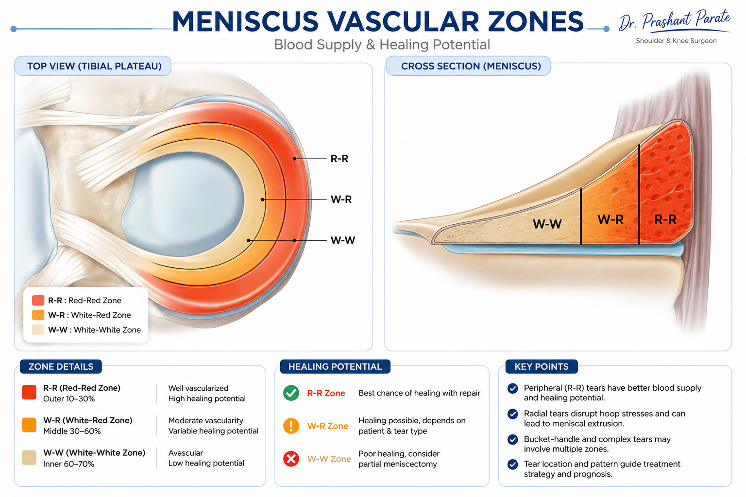 Meniscus vascular zones: red-red, white-red and white-white zones showing blood supply and healing potential. Top view and cross section. Dr. Prashant Parate